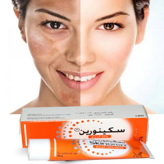 Skinoren Cream 20% Azelaic Acid - 30g